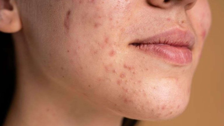 dark-spots-1678098077